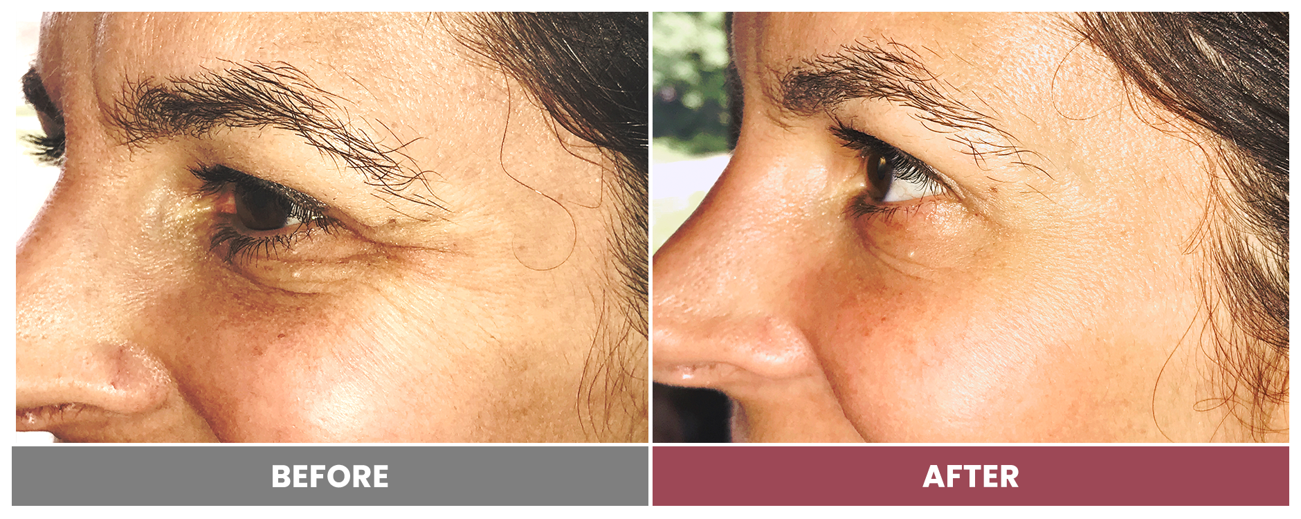 BOTOX FOR WRINKLES & BROW LIFT - Case 9